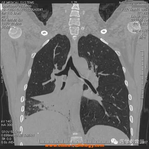 【病例】支气管异物1例CT影像表现