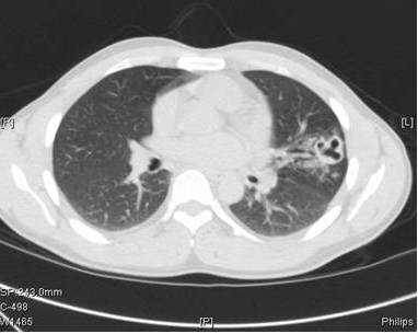 【病例】肺吸虫囊肿1例CT影像表现 【病例】肺吸虫囊肿1例CT影像表现