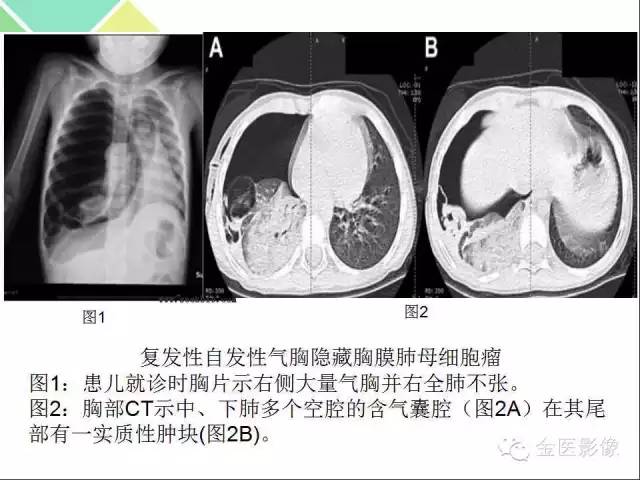 【PPT】肺不张与肺实变的影像学表现
