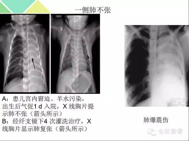 【PPT】肺不张与肺实变的影像学表现