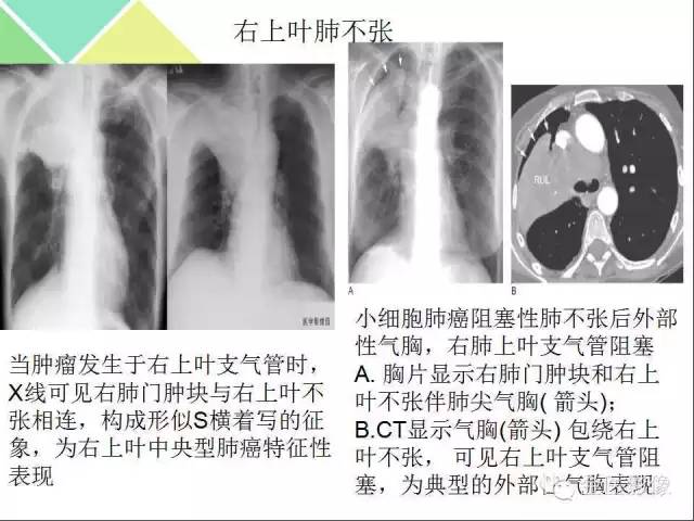 【PPT】肺不张与肺实变的影像学表现