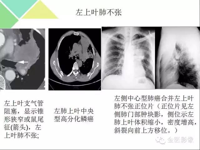 【PPT】肺不张与肺实变的影像学表现