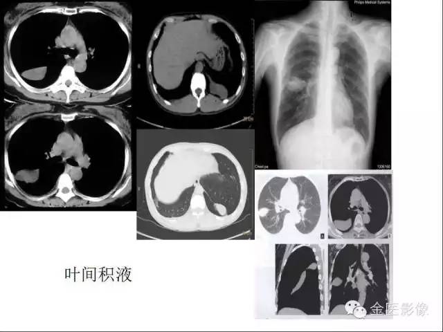 【PPT】肺不张与肺实变的影像学表现