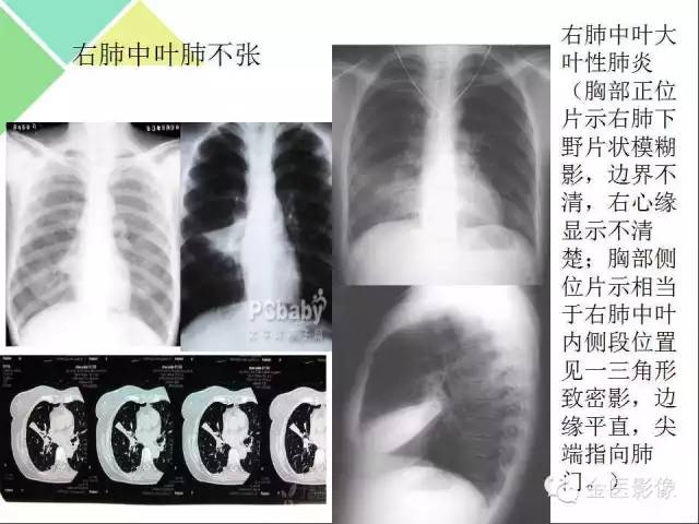 【PPT】肺不张与肺实变的影像学表现