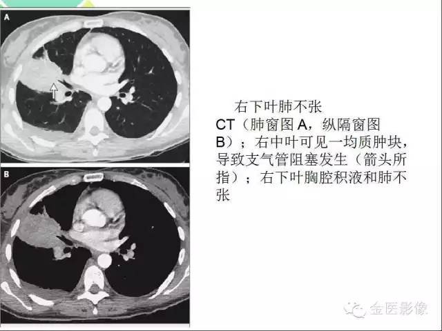 【PPT】肺不张与肺实变的影像学表现