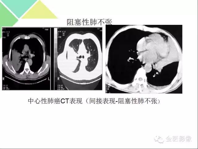 【PPT】肺不张与肺实变的影像学表现