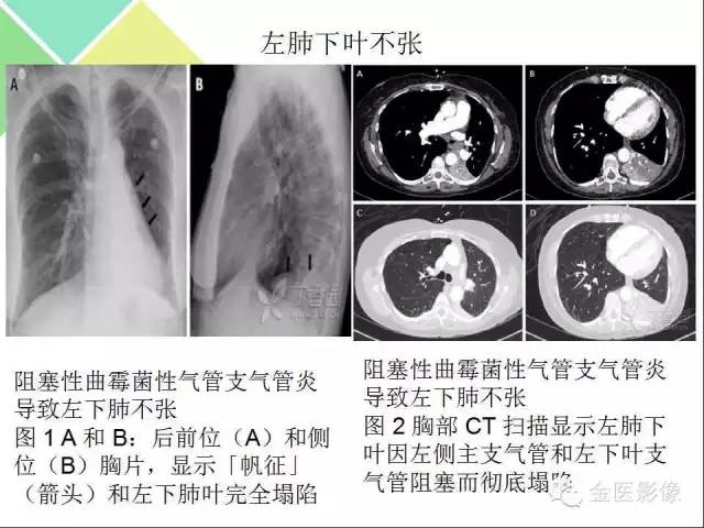 【PPT】肺不张与肺实变的影像学表现