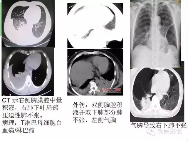 【PPT】肺不张与肺实变的影像学表现