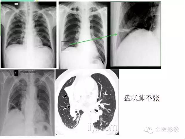 【PPT】肺不张与肺实变的影像学表现