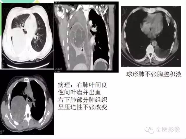 【PPT】肺不张与肺实变的影像学表现