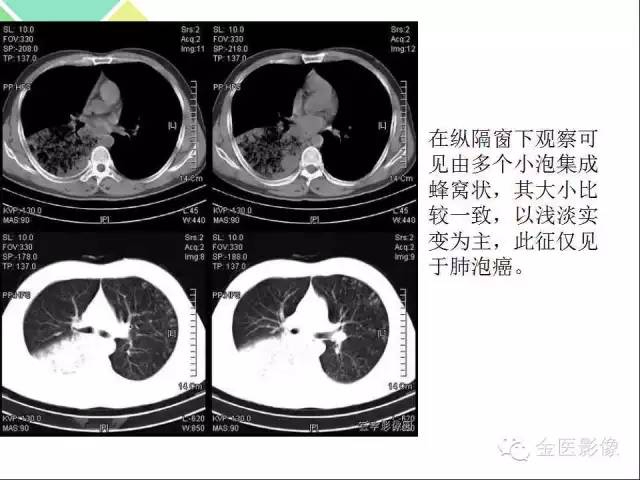【PPT】肺不张与肺实变的影像学表现