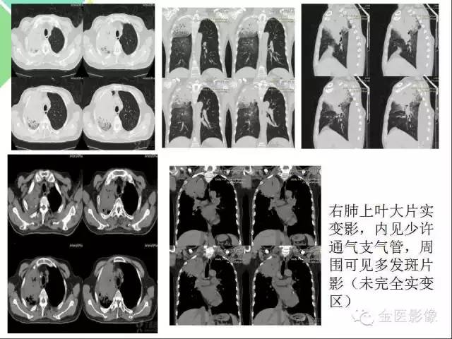 【PPT】肺不张与肺实变的影像学表现