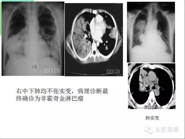 【PPT】肺不张与肺实变的影像学表现