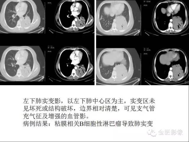 【PPT】肺不张与肺实变的影像学表现