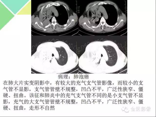 【PPT】肺不张与肺实变的影像学表现