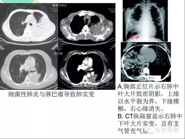 【PPT】肺不张与肺实变的影像学表现