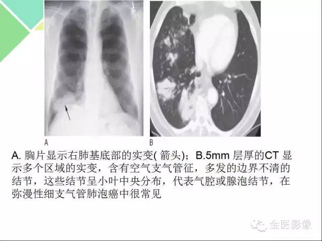 【PPT】肺不张与肺实变的影像学表现