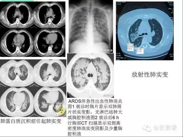 【PPT】肺不张与肺实变的影像学表现