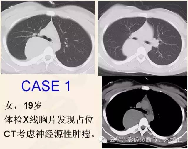 胸部富血供病变的影像鉴别诊断