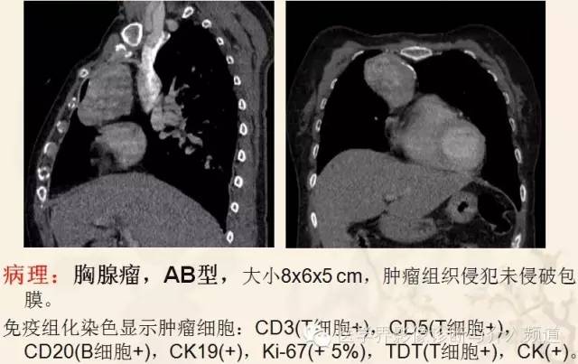 胸部富血供病变的影像鉴别诊断