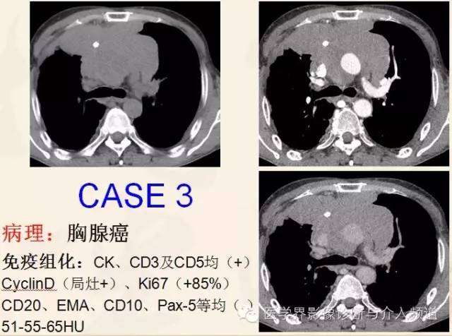 胸部富血供病变的影像鉴别诊断