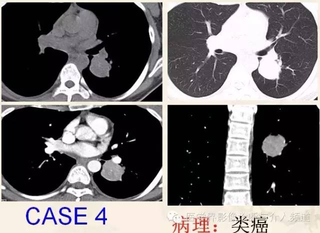 胸部富血供病变的影像鉴别诊断