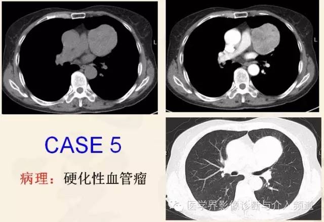 胸部富血供病变的影像鉴别诊断