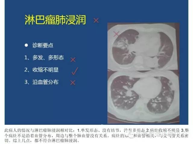 【PPT】细菌感染与真菌感染影像学的细微差别