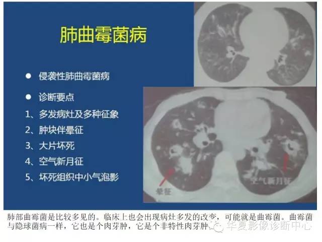 【PPT】细菌感染与真菌感染影像学的细微差别
