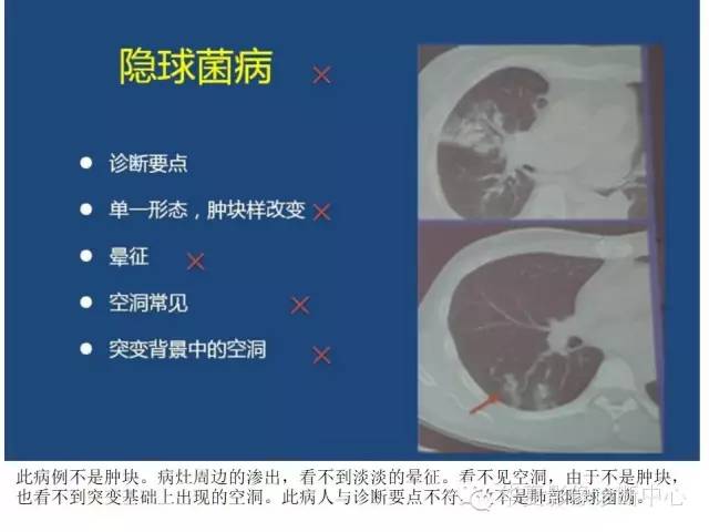 【PPT】细菌感染与真菌感染影像学的细微差别