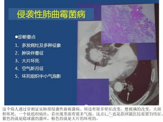 【PPT】细菌感染与真菌感染影像学的细微差别