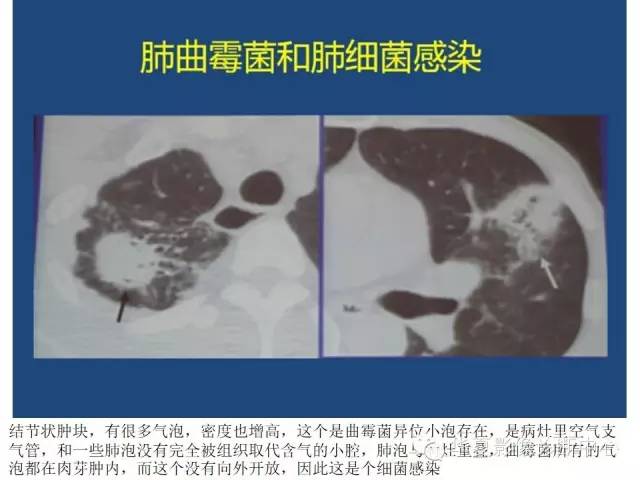【PPT】细菌感染与真菌感染影像学的细微差别