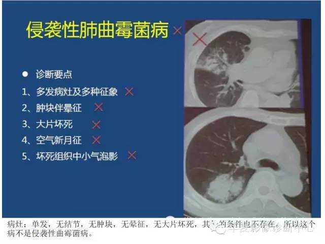 【PPT】细菌感染与真菌感染影像学的细微差别