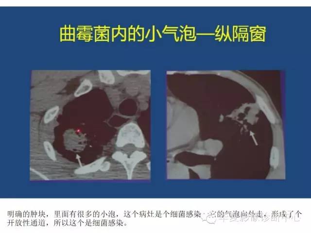 【PPT】细菌感染与真菌感染影像学的细微差别