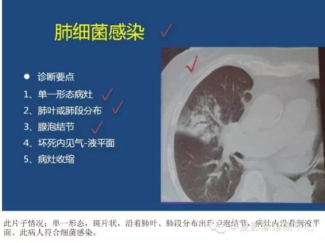 【PPT】细菌感染与真菌感染影像学的细微差别
