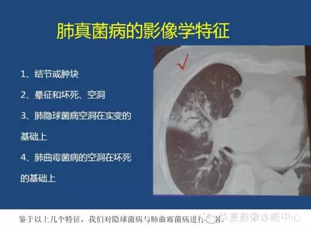 【PPT】细菌感染与真菌感染影像学的细微差别