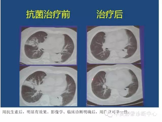 【PPT】细菌感染与真菌感染影像学的细微差别