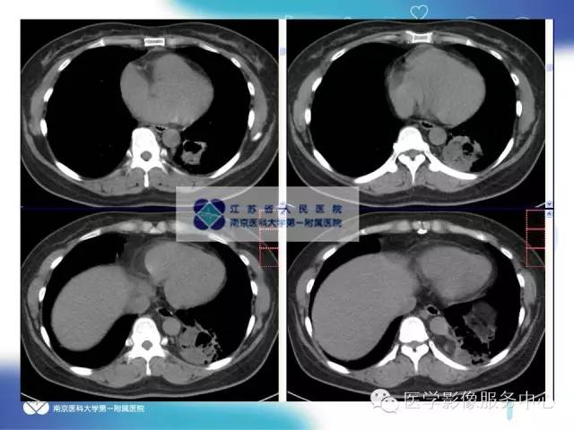 【病例】肺隔离症1例CT影像表现
