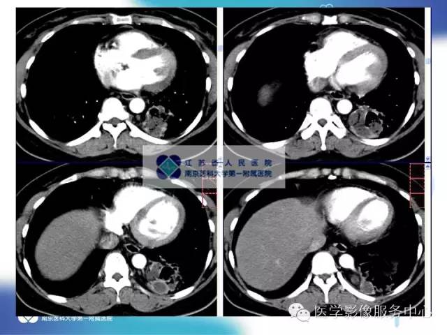 【病例】肺隔离症1例CT影像表现