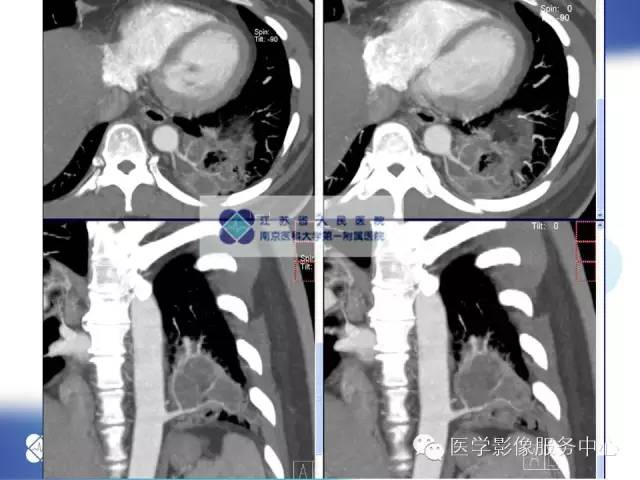 【病例】肺隔离症1例CT影像表现