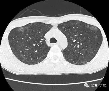 【病例】肺孢子菌肺炎影像表现1例