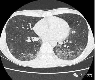 【病例】肺孢子菌肺炎影像表现1例