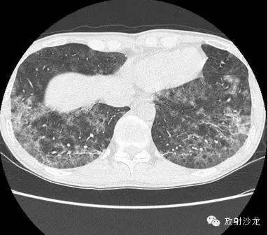 【病例】肺孢子菌肺炎影像表现1例