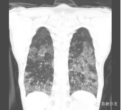 【病例】肺孢子菌肺炎影像表现1例