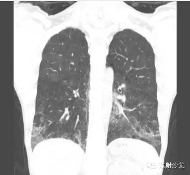 【病例】肺孢子菌肺炎影像表现1例