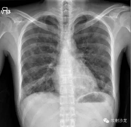 【病例】肺孢子菌肺炎影像表现1例