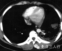 肺囊性病变的鉴别诊断 肺囊性病变的鉴别诊断