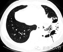 肺囊性病变的鉴别诊断 肺囊性病变的鉴别诊断