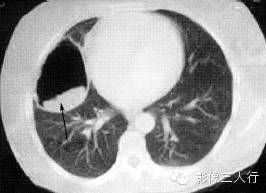 肺囊性病变的鉴别诊断 肺囊性病变的鉴别诊断