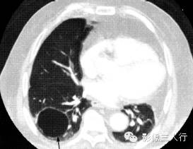 肺囊性病变的鉴别诊断 肺囊性病变的鉴别诊断